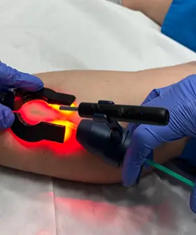 Crioesclerosis