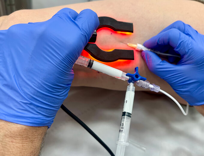 Tratamiento de varices
