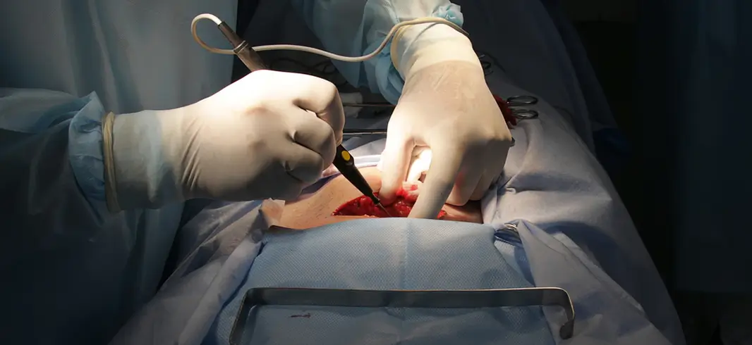 Microcirugía de varices