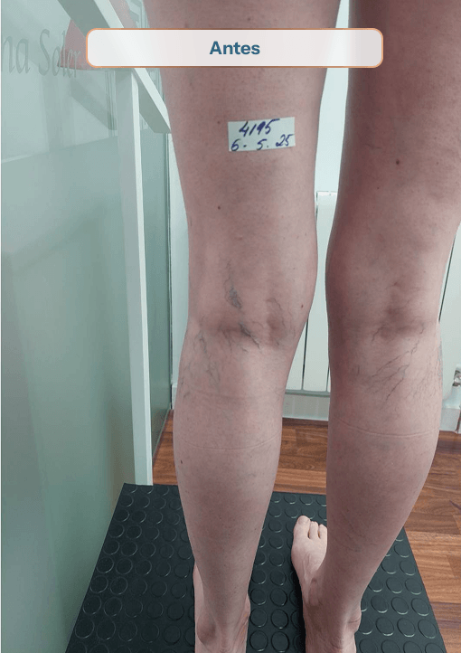4195 antes sinvarix Crioesclerosis