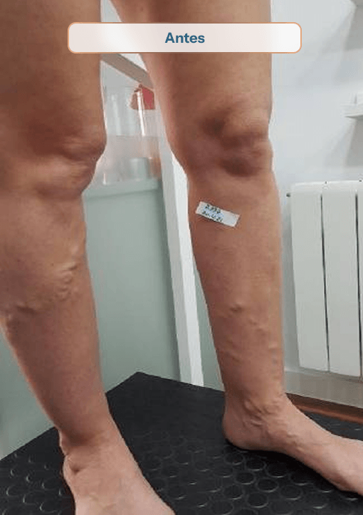 4195 antes sinvarix varices tratamiento