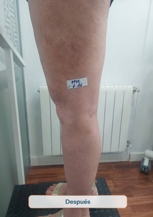 3932 despues sinvarix sinvarix medicos varices