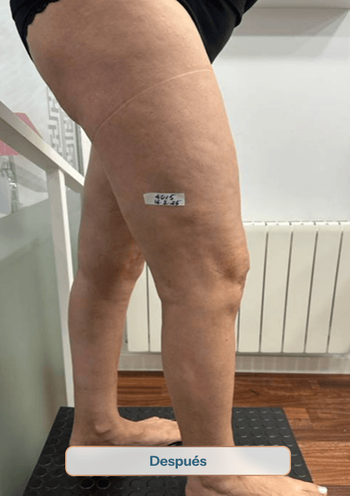 4015 despues sinvarix Tratamiento de varices sin cirugía