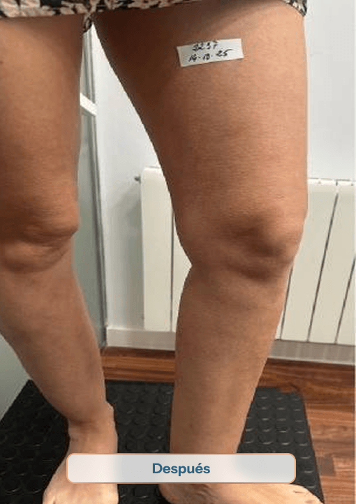 4195 despues sinvarix varices solucion