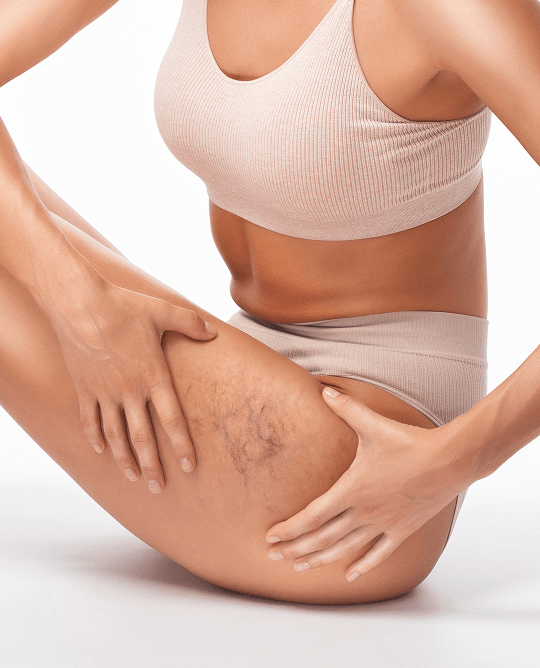 Tratamiento de varices Mujer tocandose zona afectada por varices