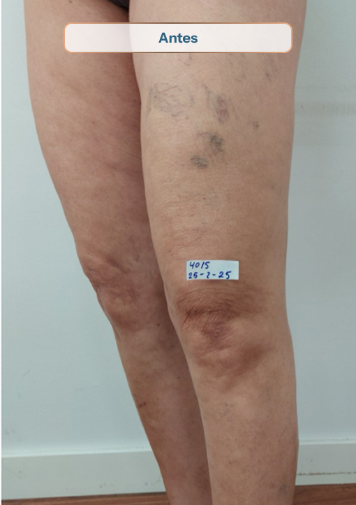 Antes-09 solución a tus varices