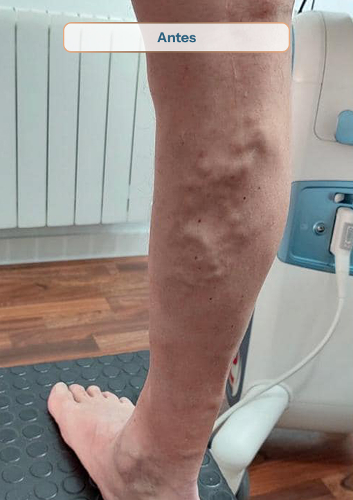 antes-10 Crioesclerosis