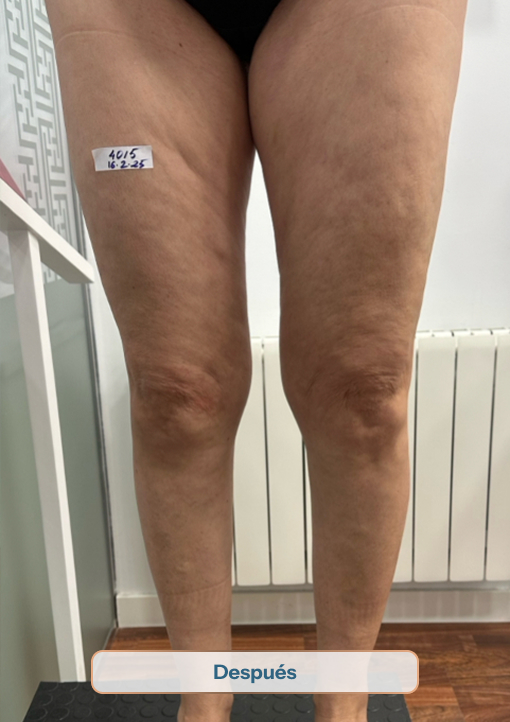 despues-09 ayuda medica a las varices